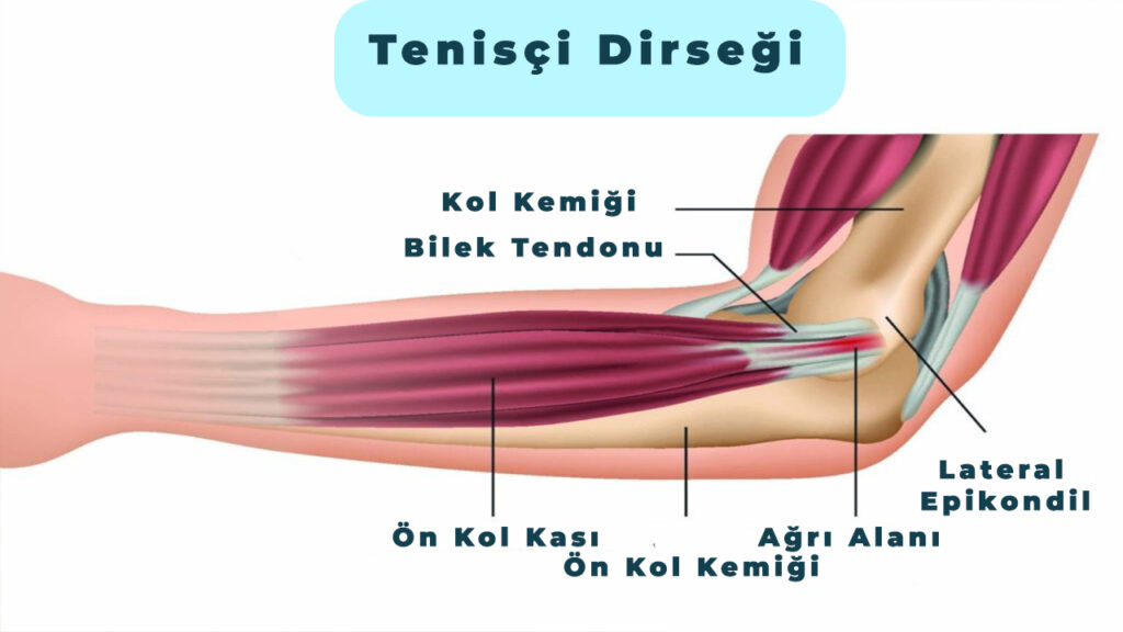 Tenisçi Dirseği – Lateral Epikondilit